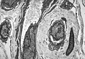 F, 48y. | lupus erythematodes … multiplicated vascular basement membrane